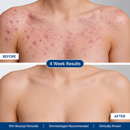 ClearOxyl™ Acne Body Spray